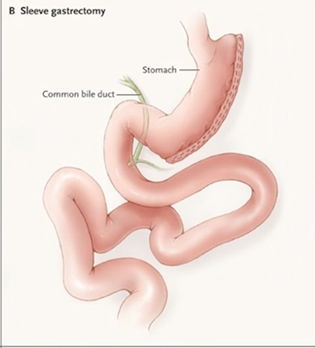 What to Expect After Gastric Sleeve Surgery