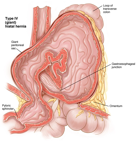 hernia10