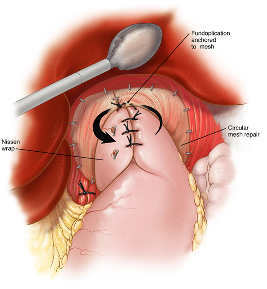 hernia13