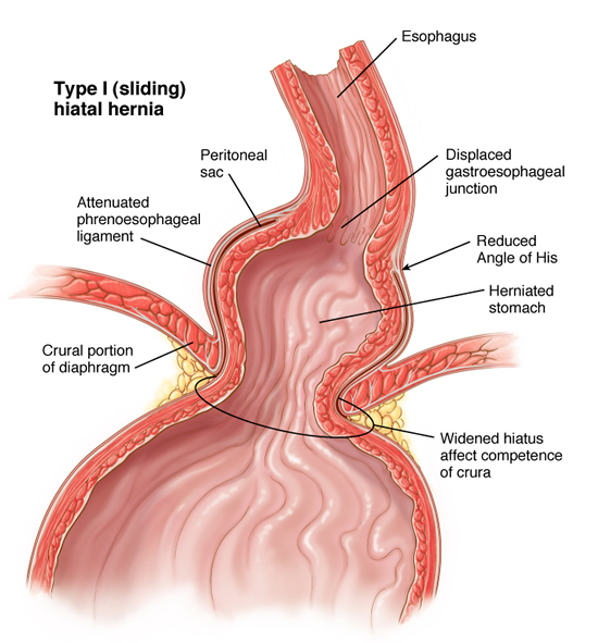 hernia7