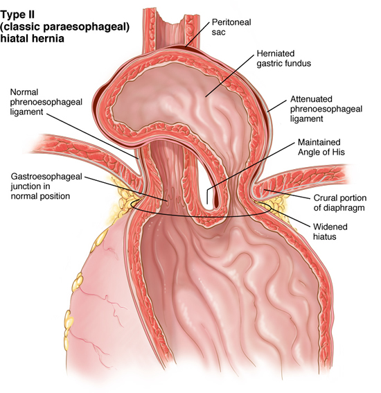 hernia8