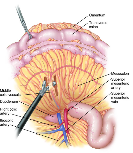 lap_olectomy3