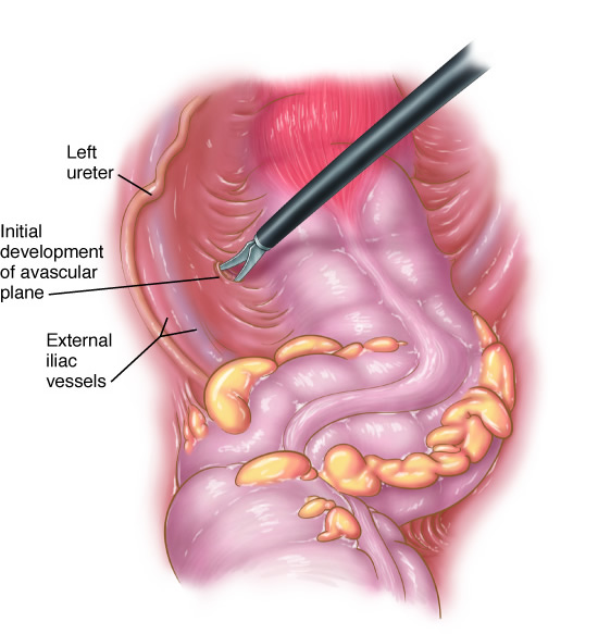 lap_olectomy4