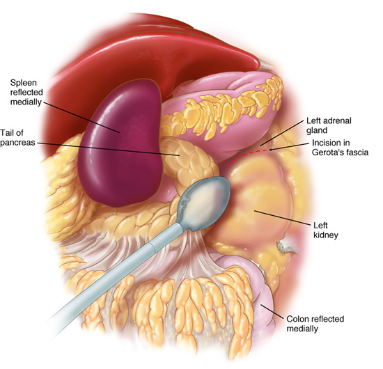 laparoscopic_adrenalectomy2