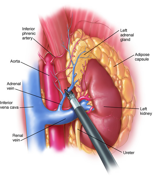 laparoscopic_adrenalectomy3